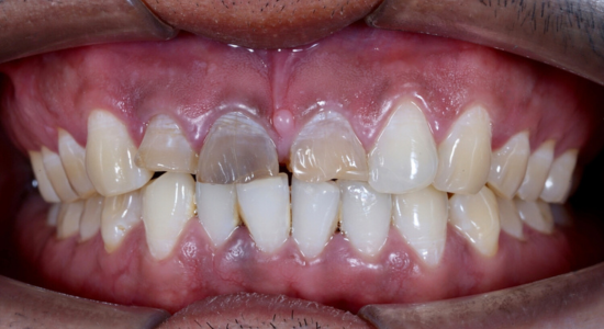 Dental Conditions Veneers Can Improve