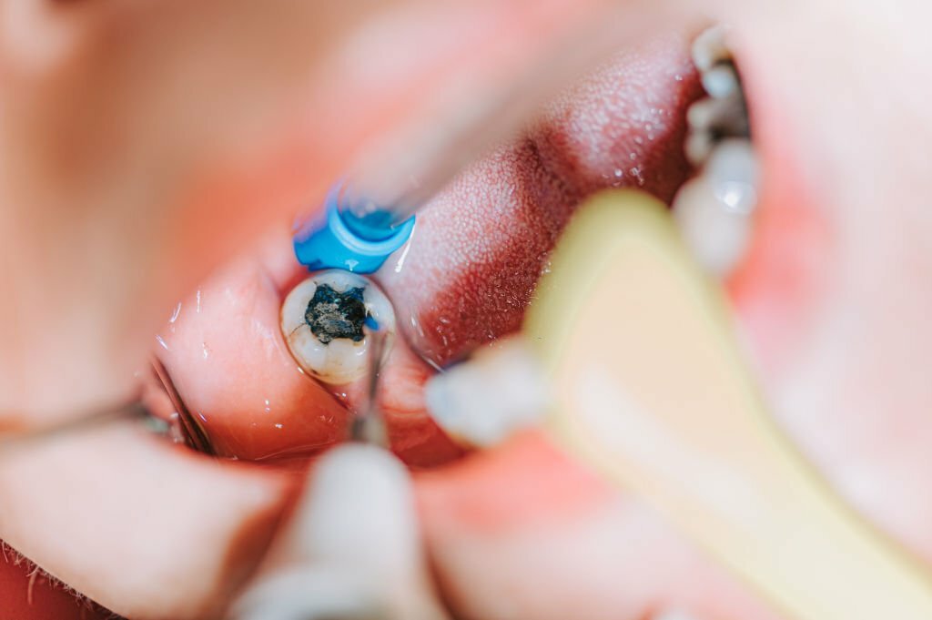 Our Root Canal Treatment Process