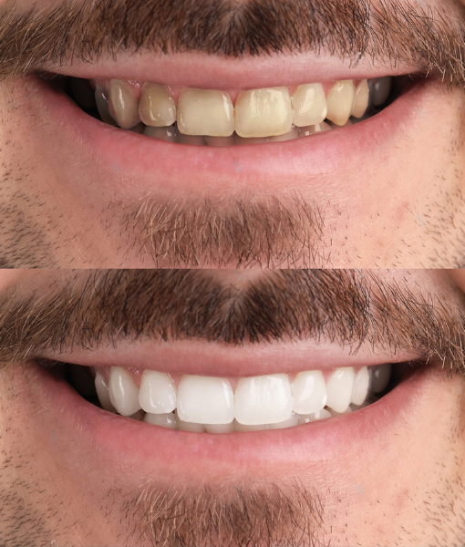 teeth whitening Fairfield, QLD
