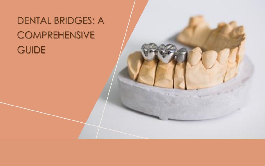 is a dental bridge permanent
