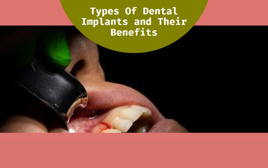 Types Of Dental Implants and Their Benefits