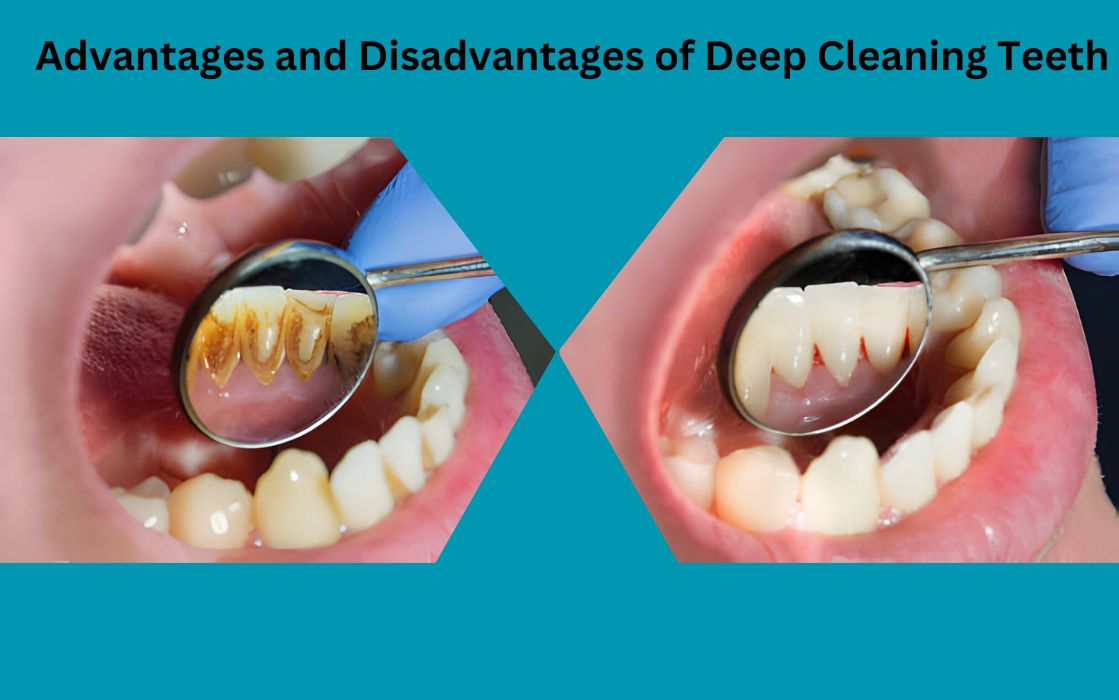 disadvantages of deep cleaning teeth