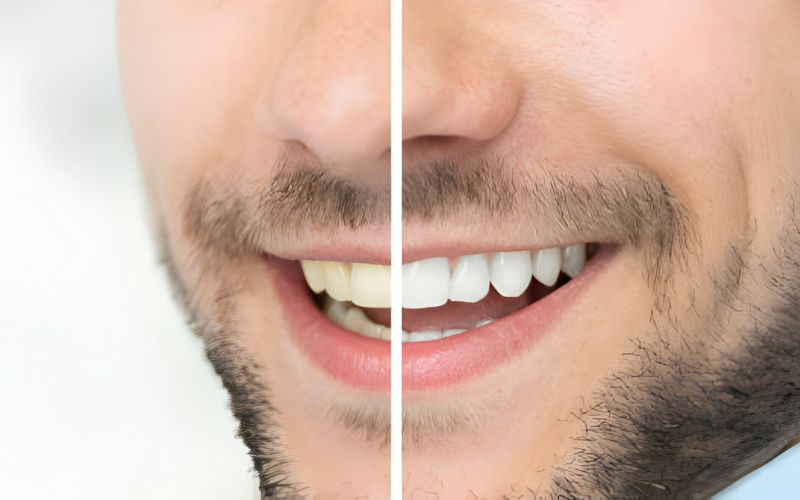 How Long Does Laser Teeth Whitening Last?