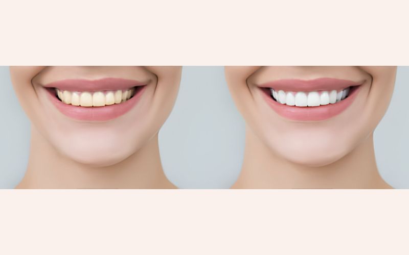 How Long Does Laser Teeth Whitening Last?