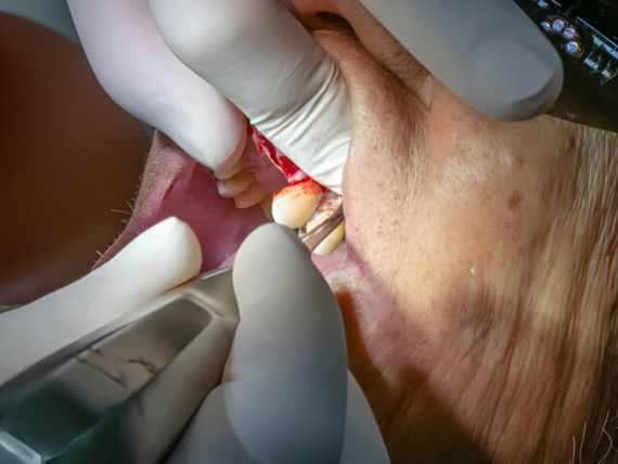 root canal annerley