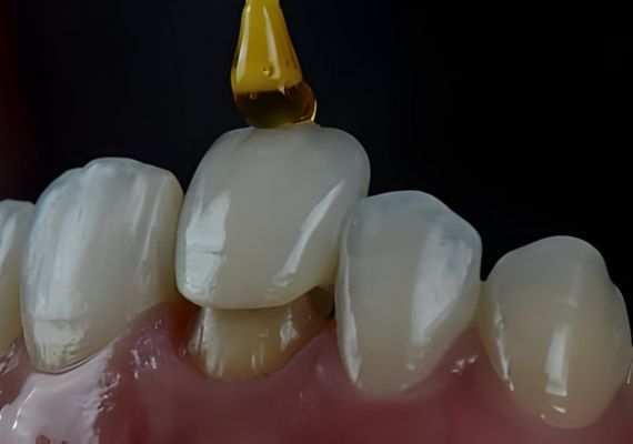 dental crowns brisbane