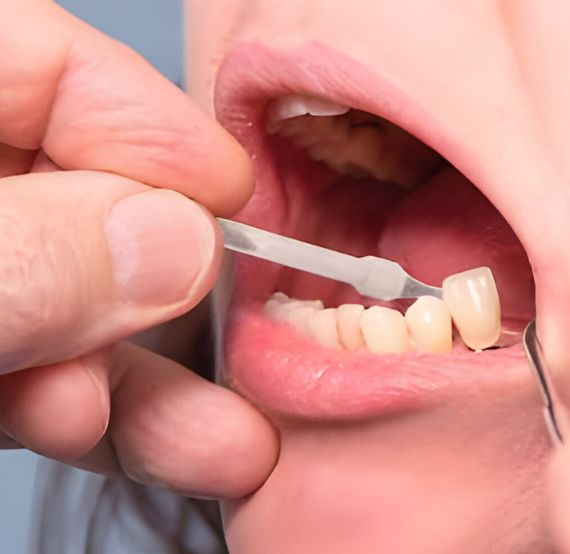 dental crowns brisbane