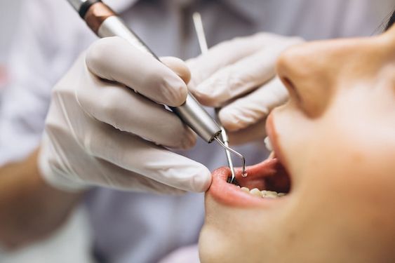 How Much Does It Cost to Do a Root Canal?