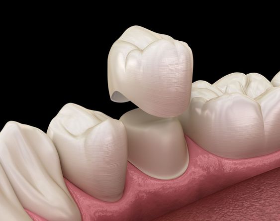 do I need dental Crown after root canal