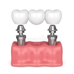 How Long Does a Dental Bridge Last?