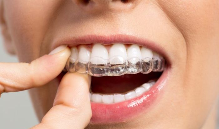 Can Invisalign Correct Overbite?