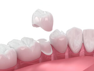 Are Dental Caps and Crowns the Same Thing