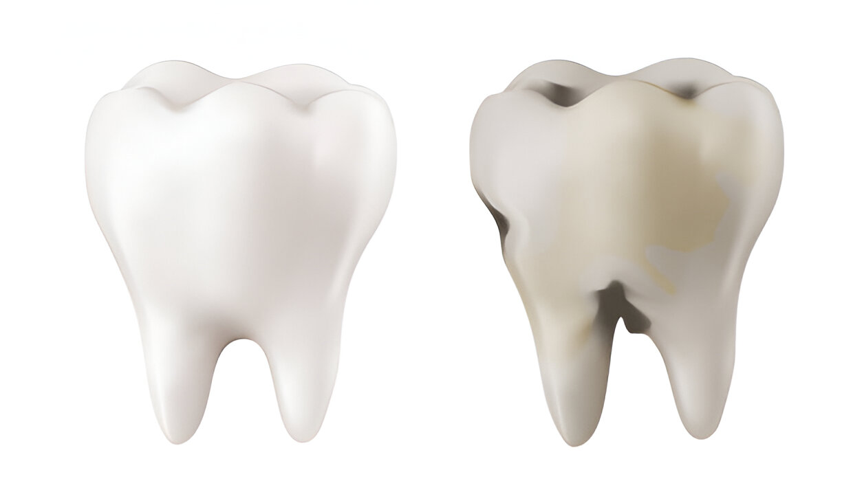 What Does a Dental Cavity Look Like?