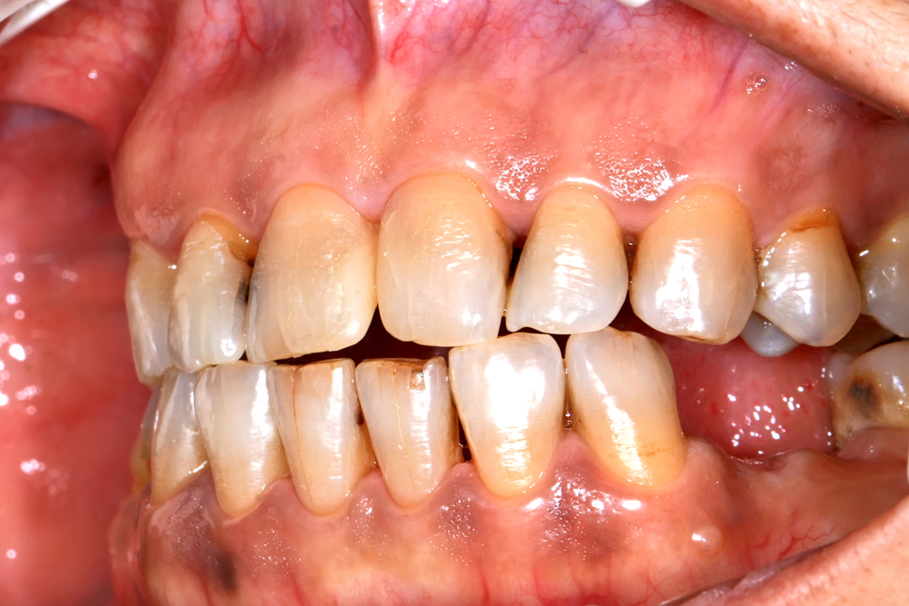 teeth having Oral Cancer