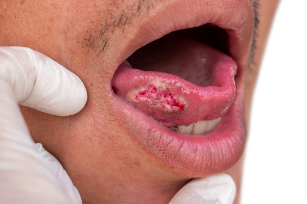 What is Oral Cancer? Signs, Symptoms, and Risk Factors