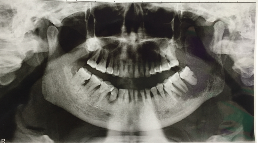 oral cancer in x-ray