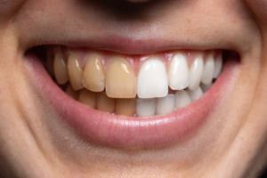 How to Get Rid of White Stains on Teeth