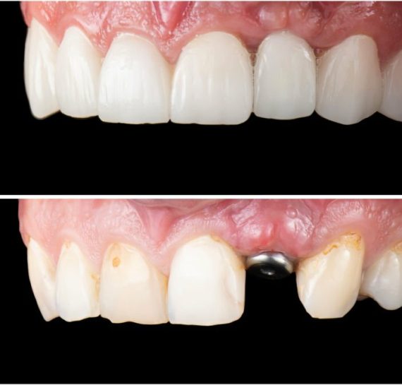 emax ceramic crowns and veneers
