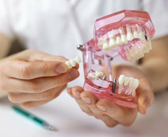 dentist implantologist showing dental bridge implant technology on human tooth jaw model