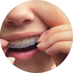 invisalign