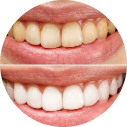 teeth whitening